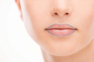Lippenunterspritzung mit Hyaluronsäure